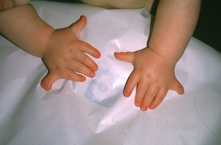 Example of polydactyly
