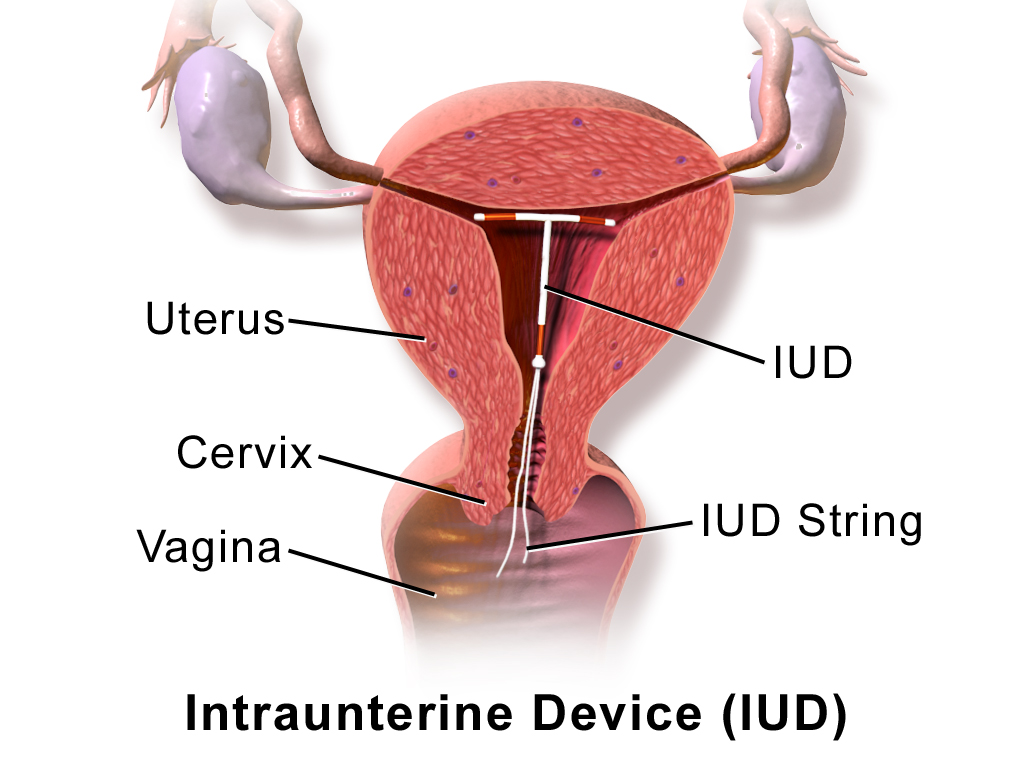 18.11.6 Intra-Uterine Device