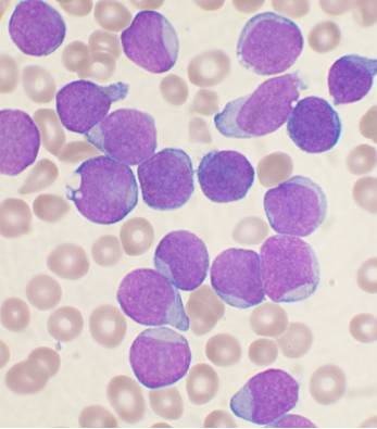 Acute Leukemia blood smear