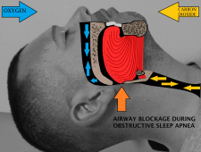 13.5 Disorders of the Respiratory System – Human Biology