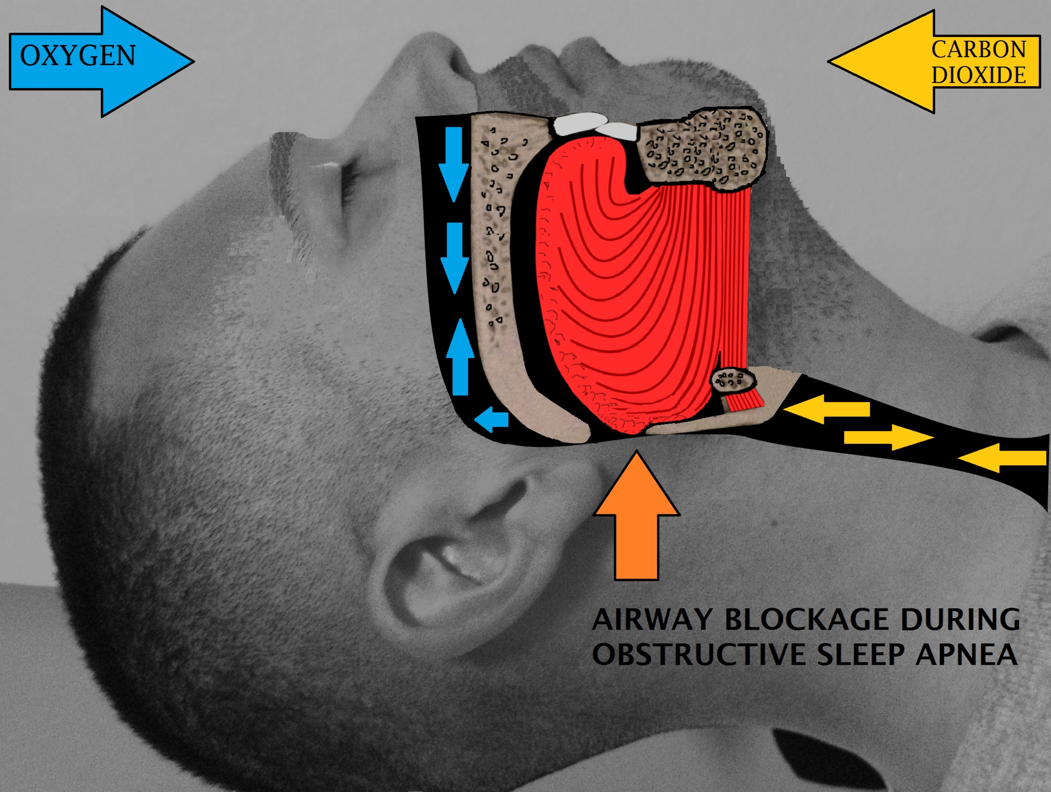 15.5.6 Sleep Apnea Airway Blockage