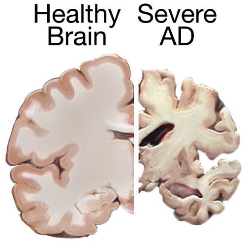 Healthy and Alzheimer's Brain Comparison