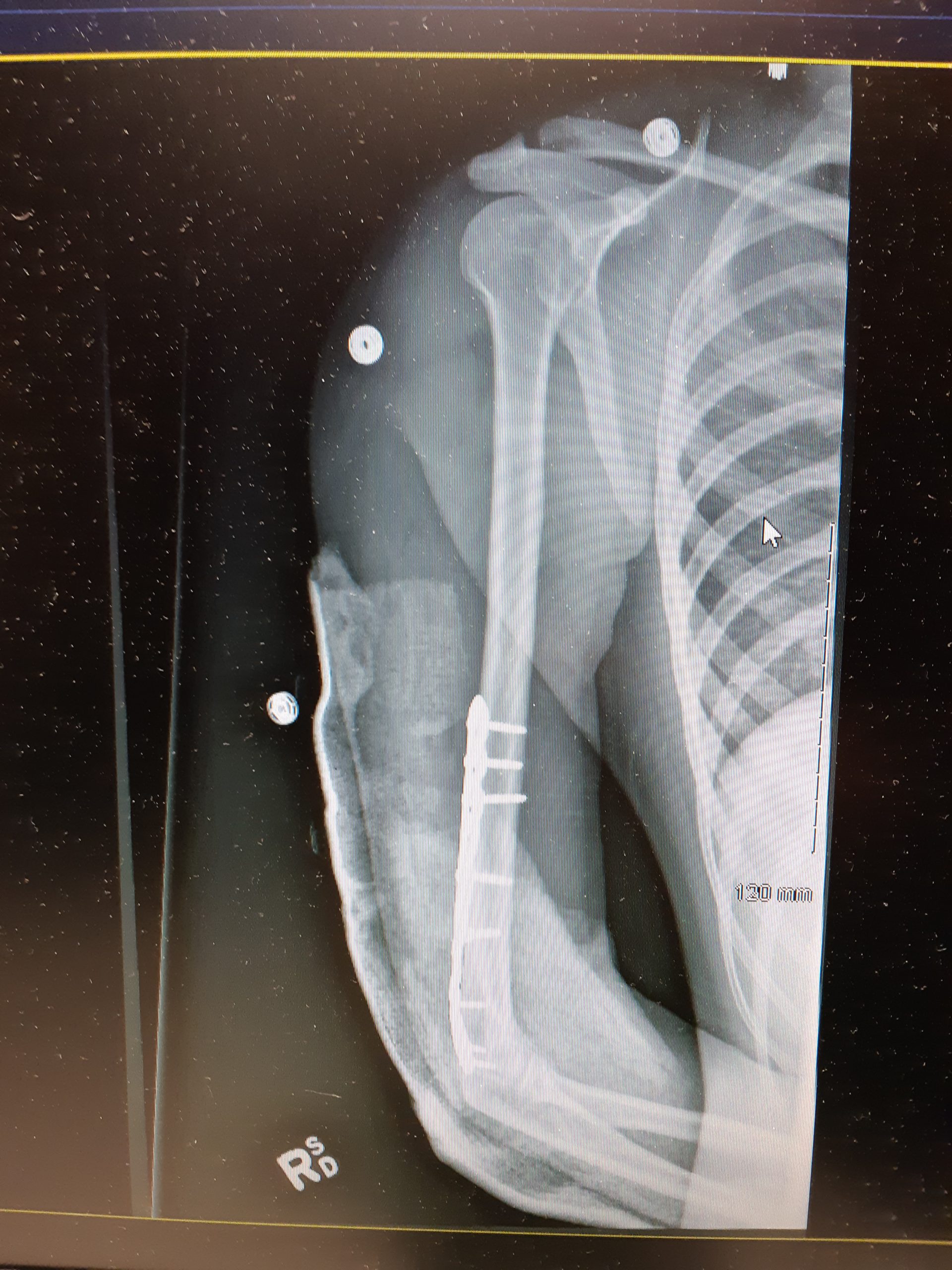 11.5.5 Broken Arm with plate and pins