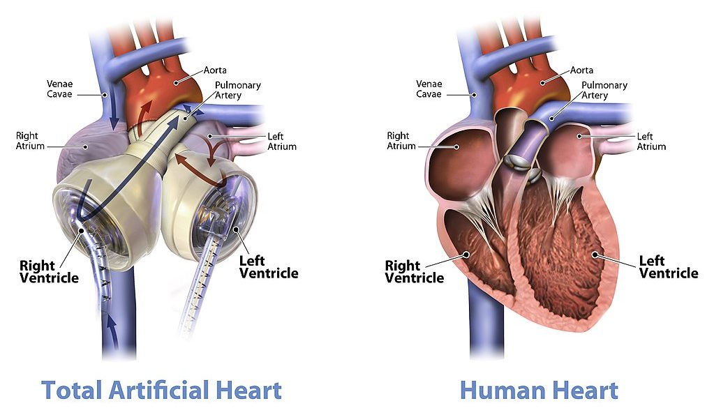 14.3.10 Total Artificial Heart