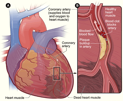 14.6.5 Myocardial infarction