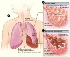 13.5 Disorders of the Respiratory System – Human Biology