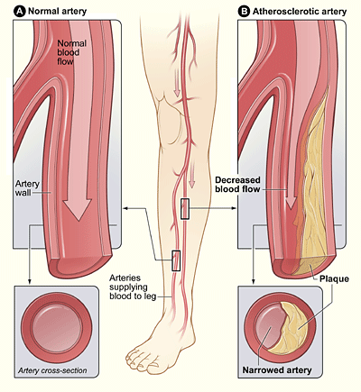 14.6.8 Peripheral Artery Disease