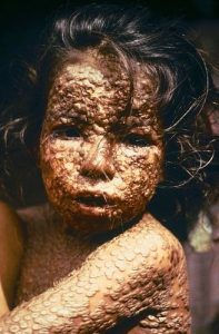A young child in Bangladesh is covered with skin lesions from smallpox. The scarring covers the child's face, including lips and eyelids, as well as the torso and arms.