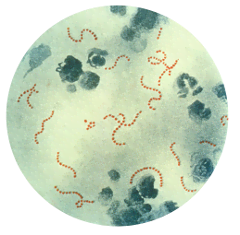 A view through a microscope showing larger irregularly oval blue cells, and strings of smaller yellow round cells. The chains of small yellow cells are the Streptococcus pyogenes.