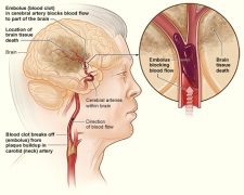 14.6 Cardiovascular Disease – Human Biology