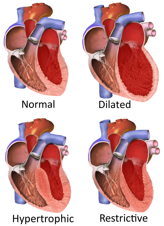 12.3 Types of Cardiomyopathy