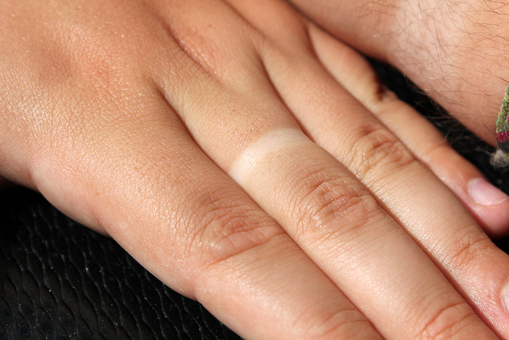 https://commons.wikimedia.org/wiki/File:Wedding_ring_tan_line_(14518898810).jpg