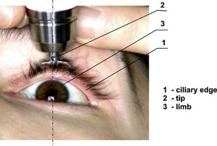 The tonometer being used by an eye care professional to determine the fluid pressure inside the eye.