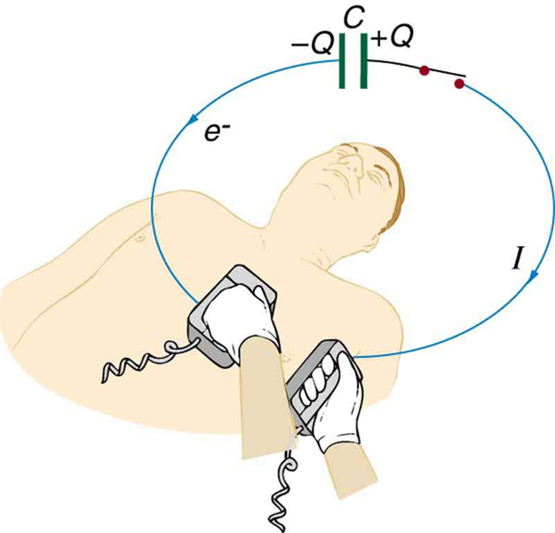 Figure represents a defibrillation unit used on a patient. The circuit is also represented. It shows a capacitor driving a current through the chest of a patient. The opposite plates of the capacitor are marked as positive Q and negative Q. The direction of current in the connecting wires from the capacitor to the defibrillation unit is shown in a clockwise direction with an arrow on the wire, and the direction of electrons is shown opposite to this direction with an arrow.