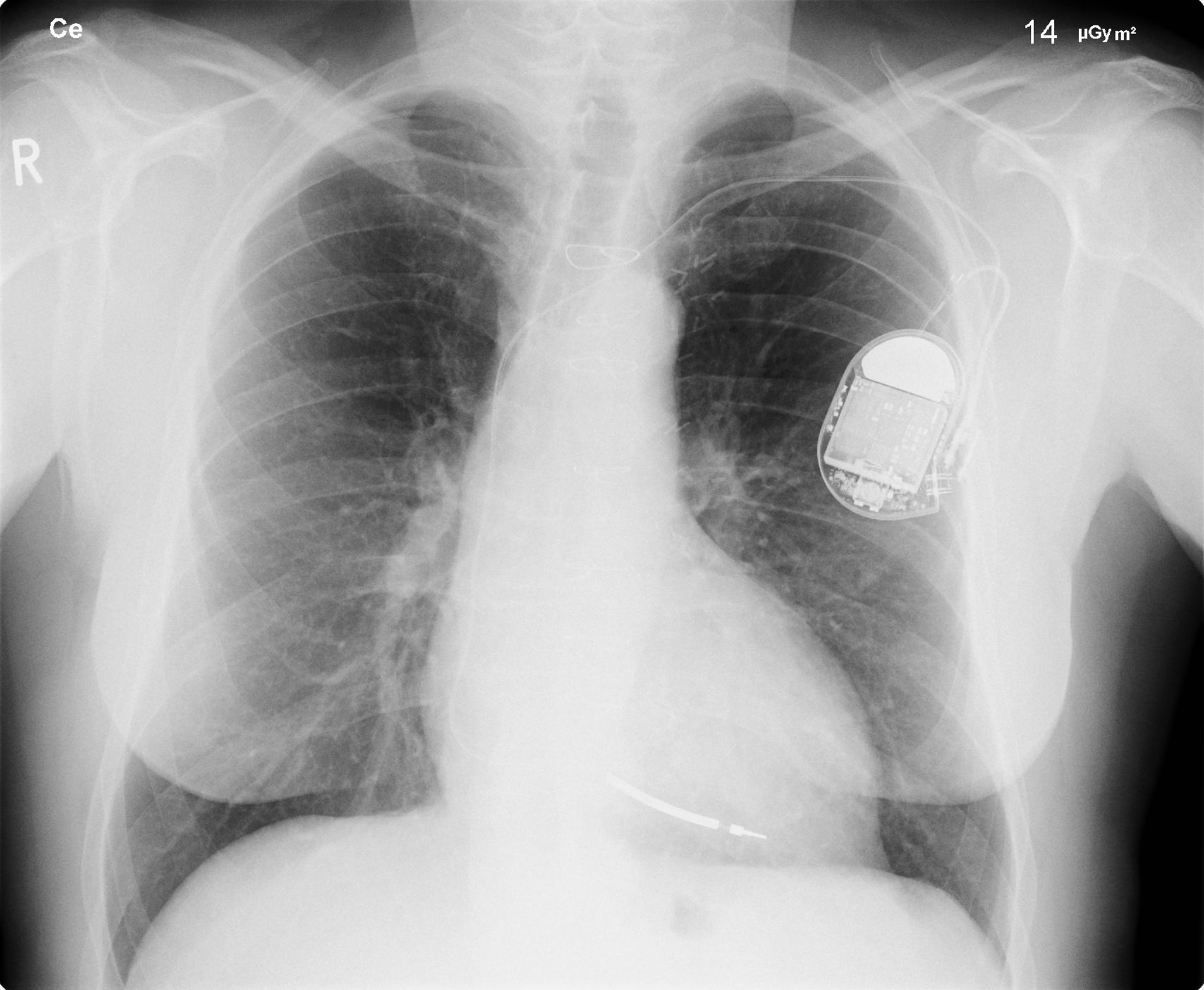 An X-ray image of a person’s chest is shown, clearly showing a pacemaker in the left side.
