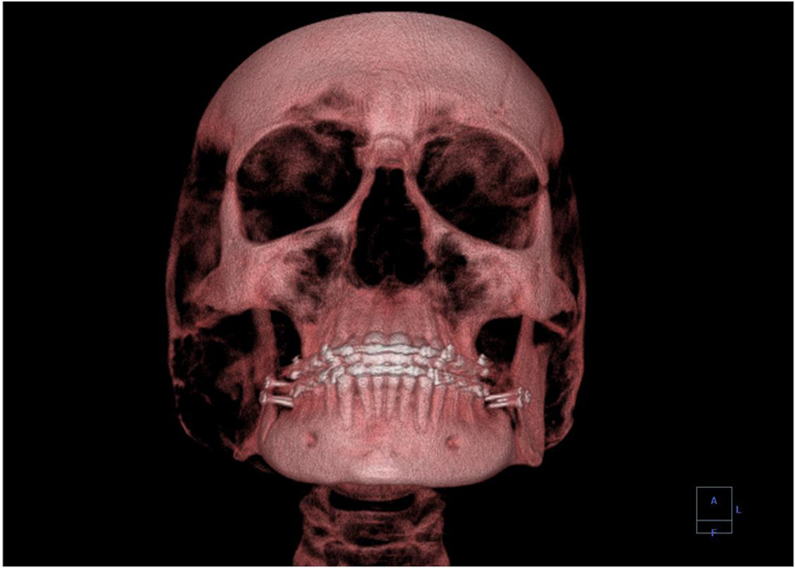 A 3-D image showing a human skull from the front.